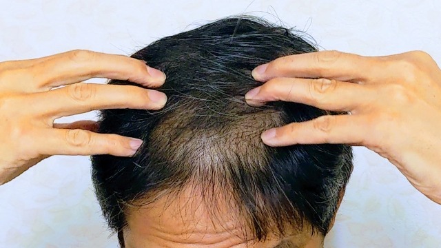 薄毛の現状